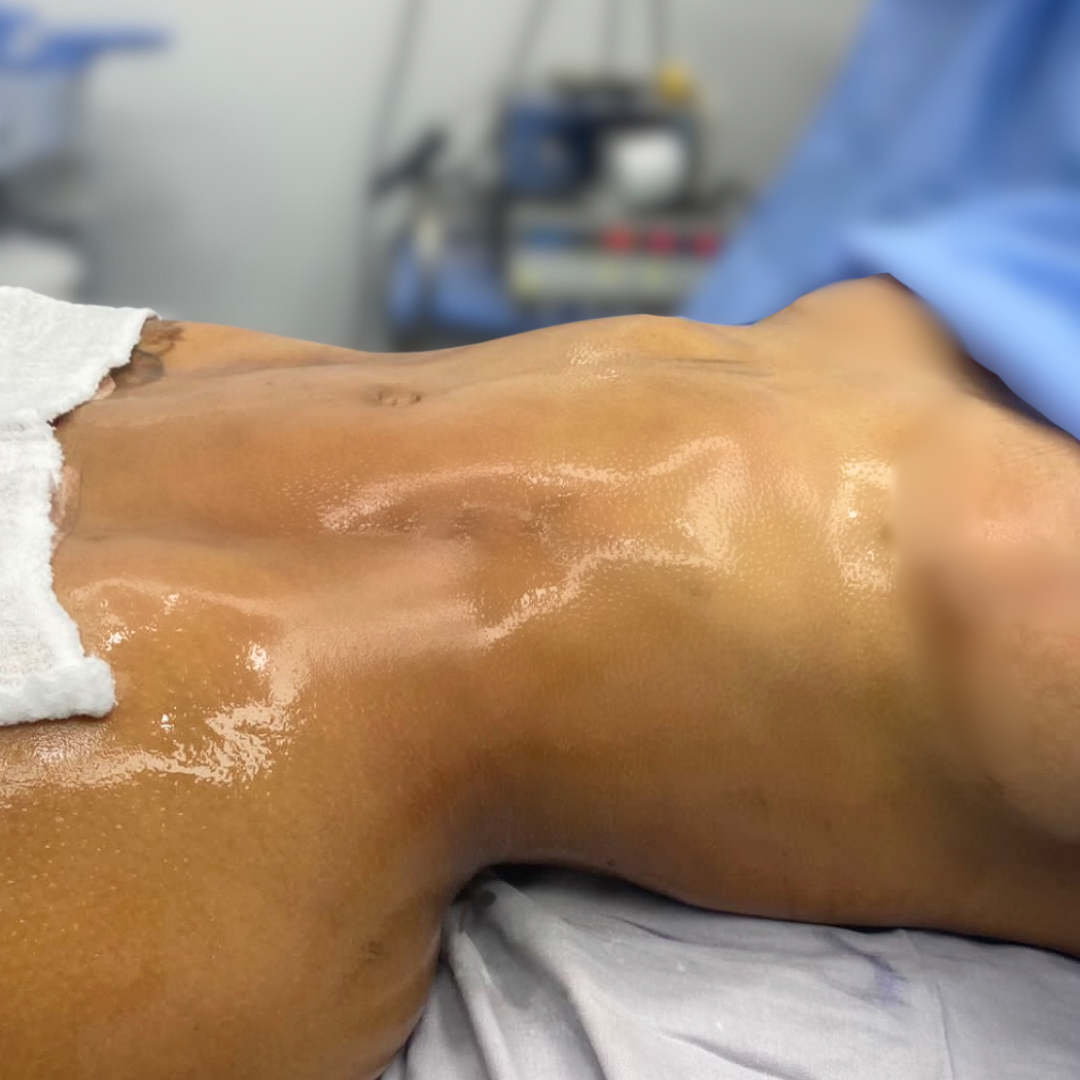 Dr. Harold Cortes performing plastic surgery at Colombian Dolls, showcasing advanced techniques in aesthetic procedures.