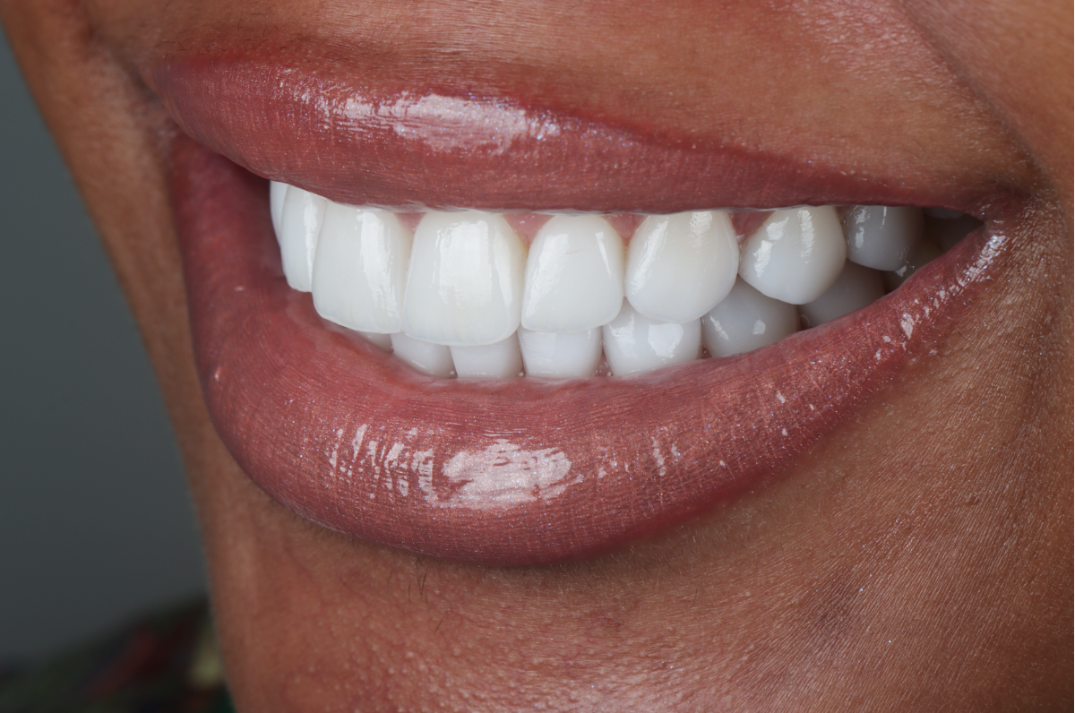 Image showing the result of dental treatment on a patient, highlighting a significant improvement in tooth alignment and overall appearance. The patient's smile is clearly enhanced, demonstrating the effectiveness of the Dr. Andres Silva dental work.